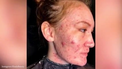 Acne treatment with sperm in face - 18 Year Old, HD Videos, Acne -  MobilePorn