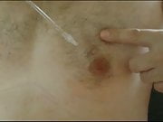 Nipples saline infusion