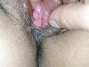 Vaginal swelling