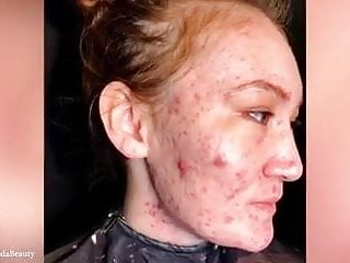 Women with very bad acne